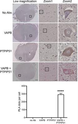 Disruption of the VAPB-PTPIP51 ER-mitochondria tethering proteins in post-mortem human amyotrophic lateral sclerosis